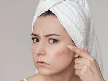 laser facial en managua